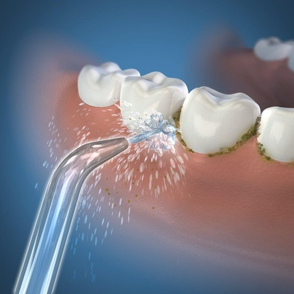 Replacement Tips Waterpik