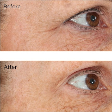 Сыворотка Perricone Md Eyelid Lift Serum