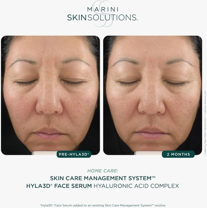 Marini Skinsolutions Hyla3D Gesichtsserum