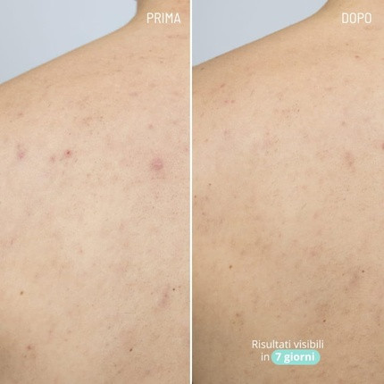 Azelaic Acid Active Body Acne Treatment Freshly Cosmetics